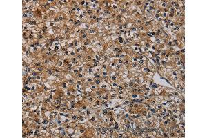 Immunohistochemistry of Human prostate cancer using TP53INP1 Polyclonal Antibody at dilution of 1:50 (TP53INP1 抗体)