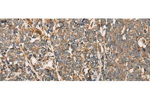 Immunohistochemistry of paraffin-embedded Human lung cancer tissue using MYL12B Polyclonal Antibody at dilution of 1:25(x200) (MYL12B 抗体)
