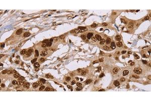 Immunohistochemistry of paraffin-embedded Human colon cancer using NUP50 Polyclonal Antibody at dilution of 1:30 (NUP50 抗体)