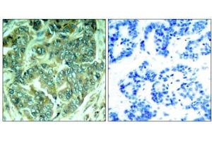 Immunohistochemical analysis of paraffin-embedded human breast carcinoma tissue, using p62Dok (phospho- Tyr398) antibody (E011277). (DOK1 抗体  (pTyr398))