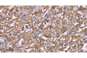 Immunohistochemistry of paraffin-embedded Human thyroid cancer using Histamine H3 Receptor Polyclonal Antibody at dilution of 1:50 (HRH3 抗体)