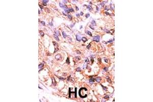 Formalin-fixed and paraffin-embedded human cancer tissue reacted with the primary antibody, which was peroxidase-conjugated to the secondary antibody, followed by AEC staining. (PPM1F 抗体  (C-Term))