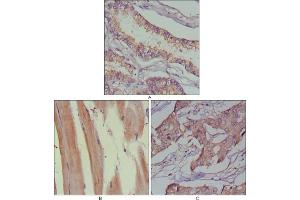 Immunohistochemical analysis of paraffin-embedded human lung cancer (A), muscles (B) and breast cancer (C) using MUSK antibody with DAB staining. (MUSK 抗体  (AA 24-209))
