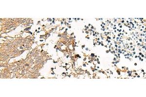 Immunohistochemistry of paraffin-embedded Human lung cancer tissue using GPR22 Polyclonal Antibody at dilution of 1:50(x200) (GPR22 抗体)