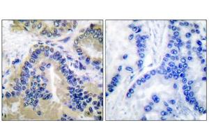 Immunohistochemical analysis of paraffin-embedded human lung carcinoma tissue, using Caspase 10 antibody. (Caspase 10 抗体  (C-Term))
