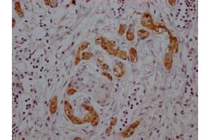 IHC image of ABIN7127620 diluted at 1:100 and staining in paraffin-embedded human pancreatic cancer performed on a Leica BondTM system. (Recombinant Midkine 抗体)
