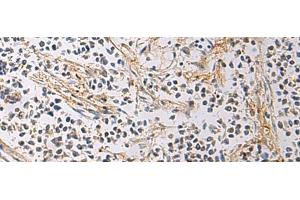 Immunohistochemistry of paraffin-embedded Human breast cancer tissue using GMPR Polyclonal Antibody at dilution of 1:60(x200) (GMPR 抗体)