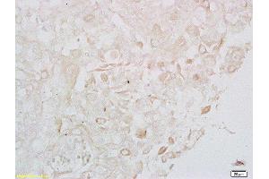 Formalin-fixed and paraffin embedded human cervical carcinoma labeled with Anti- LONP1 Polyclonal Antibody, Unconjugated  at 1:200 followed by conjugation to the secondary antibody (LONP1 抗体  (AA 361-460))