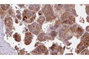 ABIN6277475 at 1/100 staining Human liver cancer tissue by IHC-P. (FSHR 抗体  (Internal Region))