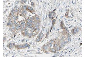 ABIN6267681 at 1/100 staining human Breast carcinoma tissue sections by IHC-P. (BAD 抗体  (pSer136))