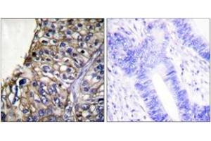 Immunohistochemistry analysis of paraffin-embedded human lung carcinoma tissue, using Claudin 7 Antibody. (Claudin 7 抗体  (AA 162-211))