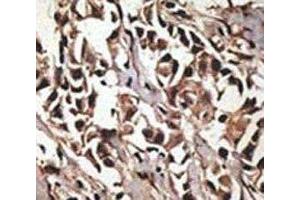 IHC analysis of FFPE human breast carcinoma tissue stained with the PRMT7 antibody (PRMT7 抗体  (AA 660-692))