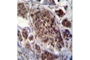 Immunohistochemistry analysis in formalin fixed and paraffin embedded human bladder carcinoma reacted with FRAT2 Antibody (C-term) followed by peroxidase conjugation of the secondary antibody and DAB staining.