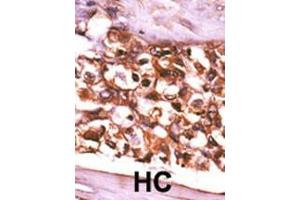Formalin-fixed and paraffin-embedded human cancer tissue reacted with the primary antibody, which was peroxidase-conjugated to the secondary antibody, followed by AEC staining. (Ribokinase 抗体  (N-Term))