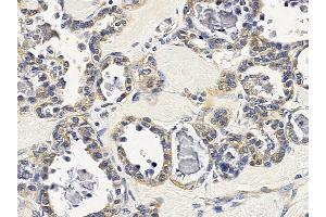ABIN6257851 and ABIN6275627 at 1/100 staining human ovarian cancer by IHC-P.