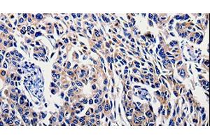 Immunohistochemistry of paraffin-embedded Human lung cancer tissue using IL10RB Polyclonal Antibody at dilution 1:60 (IL10RB 抗体)