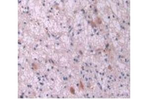 IHC-P analysis of Human Glioma Tissue, with DAB staining. (IL-2 抗体  (AA 21-153))