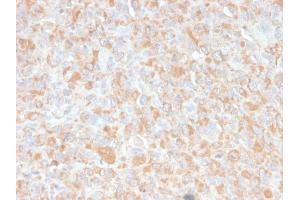 Formalin-fixed, paraffin-embedded human Histiocytoma stained with TNF alpha Mouse Monoclonal Antibody (4C6-H8). (TNF alpha 抗体  (AA 115-130))