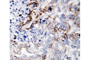 IHC-P: LAMC2 antibody testing of human lung cancer tissue (LAMC2 抗体  (C-Term))