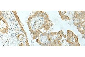 Immunohistochemistry of paraffin-embedded Human thyroid cancer tissue using ETAA1 Polyclonal Antibody at dilution of 1:25(x200) (ETAA1 抗体)