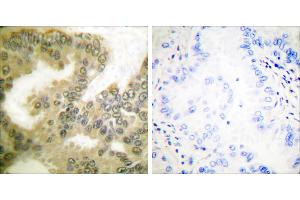 P-peptide - +Immunohistochemical analysis of paraffin-embedded human lung carcinoma tissue using Cyclin D3 (Phospho-Thr283) Antibody (#A0418). (Cyclin D3 抗体  (pThr283))