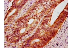 IHC image of ABIN7165258 diluted at 1:400 and staining in paraffin-embedded human colon cancer performed on a Leica BondTM system. (DEPP1 (AA 57-174) 抗体)