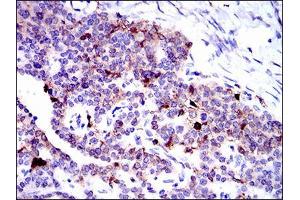 Immunohistochemical analysis of paraffin-embedded ovarian cancer tissues using ANXA1 mouse mAb with DAB staining. (Annexin a1 抗体  (AA 144-248))