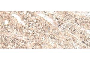 Immunohistochemistry of paraffin-embedded Human gastric cancer tissue using EXOSC9 Polyclonal Antibody at dilution of 1:35(x200) (EXOSC9 抗体)