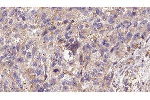 ABIN6273000 at 1/100 staining Human Melanoma tissue by IHC-P. (Glutathione Peroxidase 7 抗体  (Internal Region))