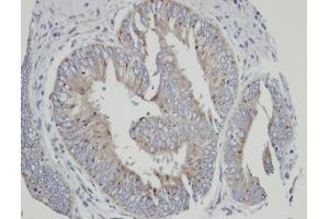 IHC-P Image Immunohistochemical analysis of paraffin-embedded human mixed ovarian cancer, using CYP4A11, antibody at 1:100 dilution. (CYP4A11 抗体  (Center))