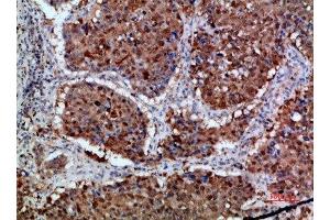 Immunohistochemical analysis of paraffin-embedded human-lung-cancer, antibody was diluted at 1:200 (Integrin alpha 1 抗体  (AA 920-980))
