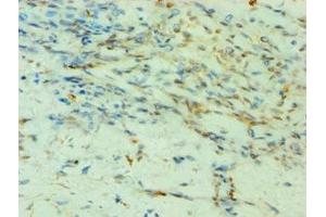 Immunohistochemistry of paraffin-embedded human breast cancer using ABIN7155523 at dilution of 1:100 (SMYD3 抗体  (AA 199-428))