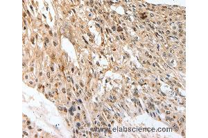 Immunohistochemistry of Human esophagus cancer using SLC1A7 Polyclonal Antibody at dilution of 1:60 (SLC1A7 抗体)