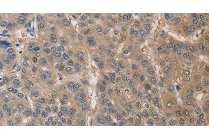 Immunohistochemistry of paraffin-embedded Human liver cancer using DPYSL3 Polyclonal Antibody at dilution of 1:30 (DPYSL3 抗体)