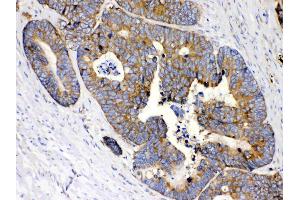 MPS1 was detected in paraffin-embedded sections of human intetsinal cancer tissues using rabbit anti- MPS1 Antigen Affinity purified polyclonal antibody (Catalog # ) at 1 ? (RPS27 抗体  (AA 2-84))