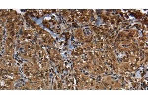Immunohistochemistry of paraffin-embedded Human thyroid cancer using GLO1 Polyclonal Antibody at dilution of 1:50 (GLO1 抗体)