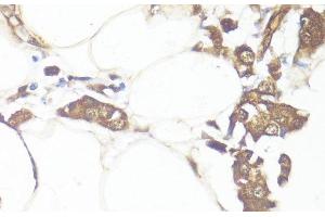 Immunohistochemistry of paraffin-embedded Human breast cancer using SMAD7 Polyclonal Antibody at dilution of 1:100 (40x lens). (SMAD7 抗体)