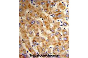 Formalin-fixed and paraffin-embedded human hepatocarcinoma reacted with HYOU1 Antibody , which was peroxidase-conjugated to the secondary antibody, followed by DAB staining. (HYOU1 抗体  (AA 274-303))