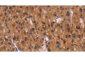 Immunohistochemistry of paraffin-embedded Human liver cancer tissue using ID2 Polyclonal Antibody at dilution 1:30 (Id2 抗体)