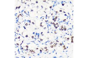 Immunohistochemistry of paraffin-embedded Human liver cancer using MYEF2 Rabbit pAb (ABIN7268721) at dilution of 1:100 (40x lens). (MYEF2 抗体  (AA 1-120))