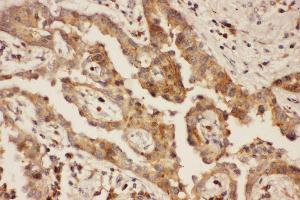 Anti-CXCR3 Picoband antibody,  IHC(P): Human Lung Cancer Tissue (CXCR3 抗体  (AA 1-368))