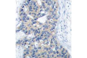 Immunohistochemistry of paraffin-embedded human breast carcinoma using Phospho-STMN1-S38 antibody (ABIN2987644). (Stathmin 1 抗体  (pSer38))