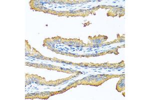 Immunohistochemistry of paraffin-embedded human prostate using TAC1 antibody at dilution of 1:100 (40x lens). (TAC1 抗体)