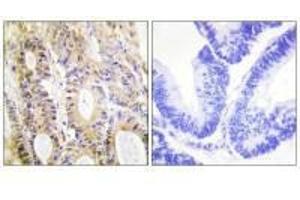 Immunohistochemistry analysis of paraffin-embedded human colon colon tissue using Smad3 (Ab-204) antibody.