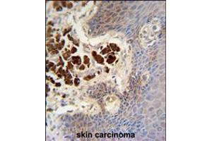 COL19A1 antibody immunohistochemistry analysis in formalin fixed and paraffin embedded human skin carcinoma followed by peroxidase conjugation of the secondary antibody and DAB staining. (COL19A1 抗体  (N-Term))