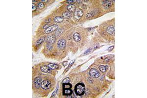 Formalin-fixed and paraffin-embedded human breast cancer tissue reacted with RPS6KB1 polyclonal antibody  , which was peroxidase-conjugated to the secondary antibody, followed by DAB staining.