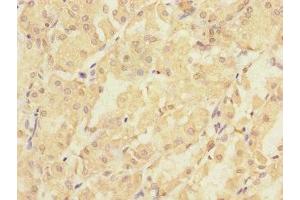 Immunohistochemistry of paraffin-embedded human gastric cancer using ABIN7163386 at dilution of 1:100 (PMM2 抗体  (AA 1-246))