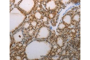 Immunohistochemistry of Human thyroid cancer using S100A1 Polyclonal Antibody at dilution of 1:70 (S100A1 抗体)