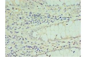 Immunohistochemistry of paraffin-embedded human colon cancer using ABIN7172637 at dilution of 1:100 (SOX6 抗体  (AA 1-74))