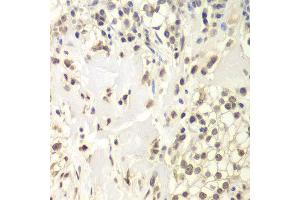 Immunohistochemistry of paraffin-embedded human kidney cancer using USP7 antibody at dilution of 1:200 (400x lens).